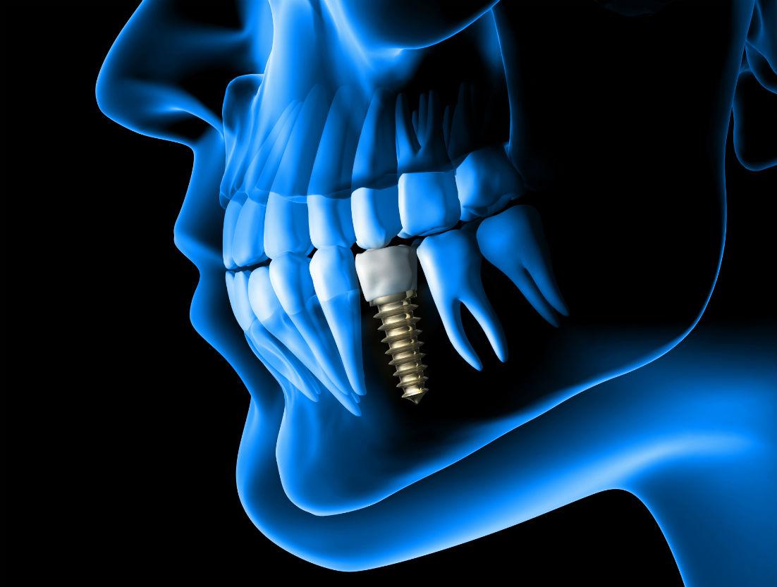 Dental Implants Falls Church, VA